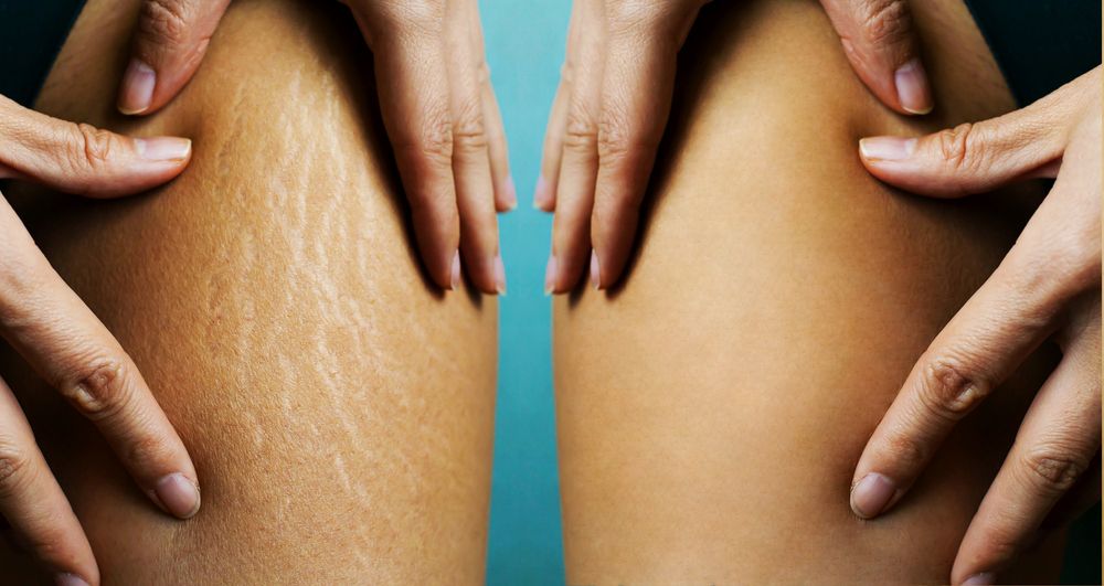 The Truth About Home Remedies for Leg Stretch Marks (and Why You Should Consider Professional Treatments in South Florida)